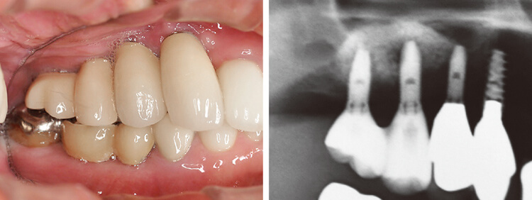 最終補綴装着時の口腔内およびX線写真