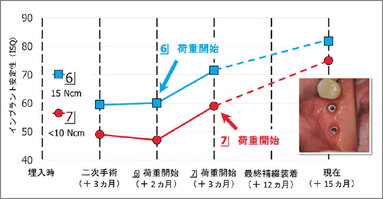 ISQ値の経時的変化（症例2）