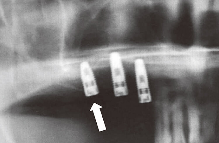 インプラント埋入術直後のX線写真