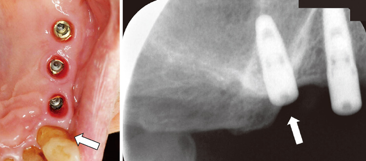 6 違和感出現時の口腔内およびX線写真