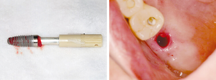 6 インプラント脱落時のインプラント体および口腔内写真