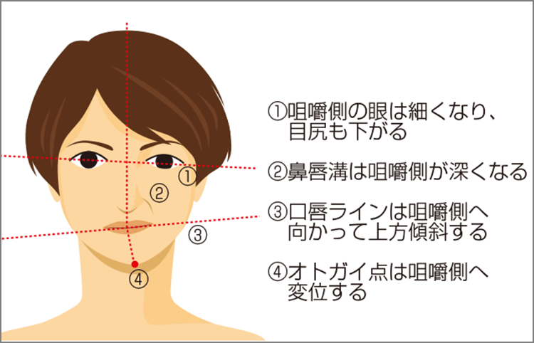 表情筋や咀嚼筋の硬縮がもたらす顔の歪み（左偏咀嚼癖による顔貌の変化）