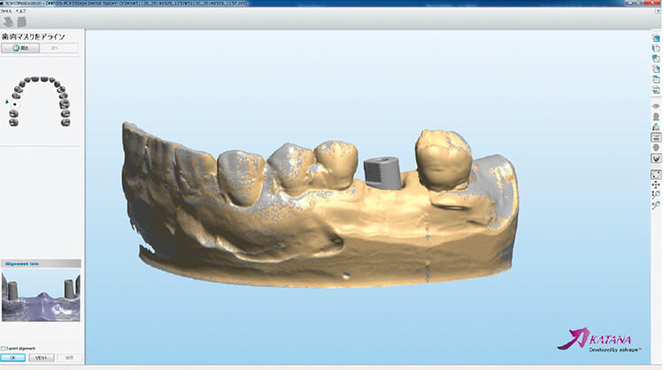 歯肉模型のデータとスキャンアダプターつきの模型データを合成する。