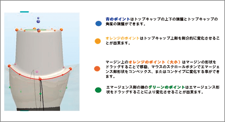 アバットメント形状をデザイン。ポイントをつまんだり、ドラッグしたりすることでデザインを調整できる。