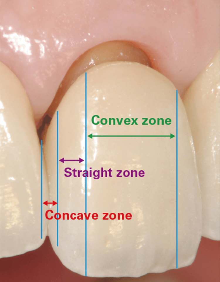 subgingival contourの与え方（藤原康則先生）