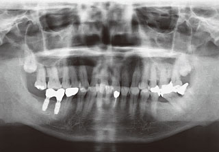 術後1年パノラマX線写真
