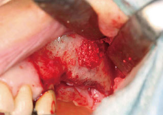 上顎洞粘膜挙上術中写真
