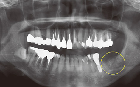 図2 初診時パノラマX線写真。