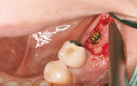 図4 術前診断で決めていた部位にフィクスチャーを2本埋入した。