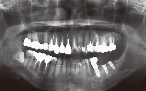 図5 術後パノラマ写真。