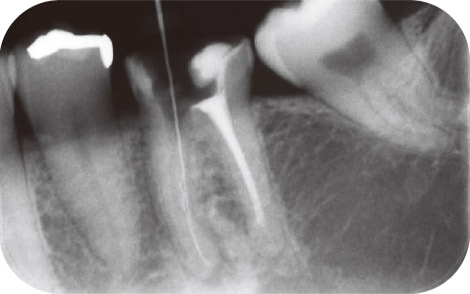 図8 来院を重ねて根管拡大、形成を行ったがリーマー使用時の手指感覚や電気的根管長測定器などの異音がしたために、デンタル撮影を行ったところ、パノラマ時には認められなかったリーマー破折片らしきものが写ったために、CT撮影を行い確認した。　
