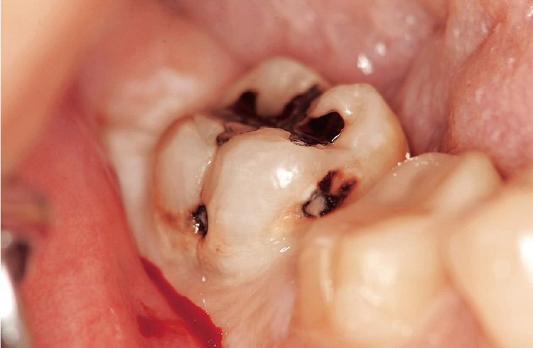 図3 ７ には複数のう蝕が認められた。