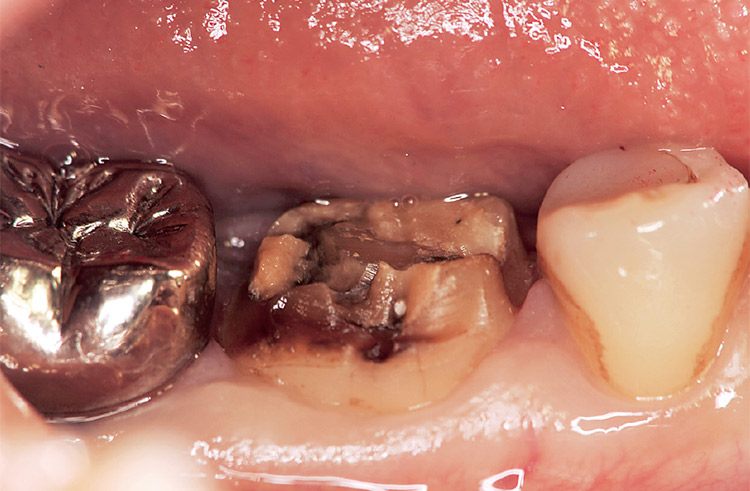 図14 クラウンを除去すると大量の感染歯質を認めた。