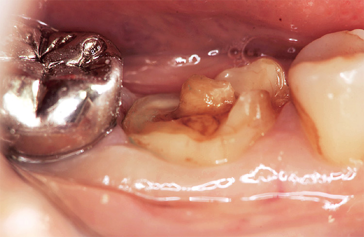 図15 感染歯質を全て除去すると露髄はまねがれたが健全歯質が不足し、支台築造が必要となった。