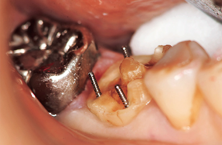 図16 健全歯質の少なさを補うために歯冠修復用金属ピンを植立した。