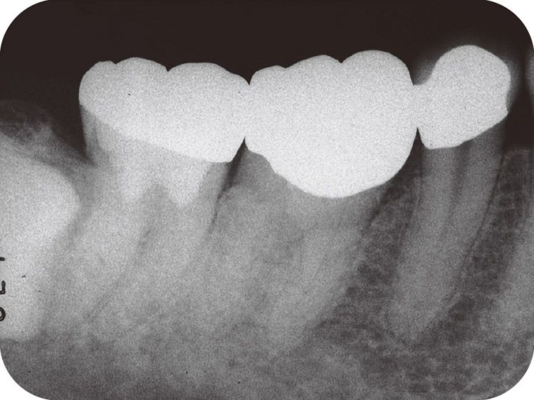図19 最終補綴処置後6ヵ月のX線像。症状は消失し、根尖部に透過像も認めない。