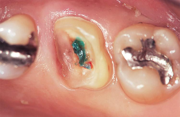 図22 出血を避けながら歯肉縁下カリエスを除去。