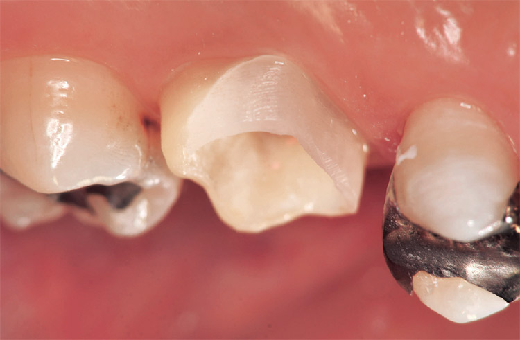 図23 バルクベースで隔壁を作製し、唾液の侵入防止と仮封材の厚みを確保した。