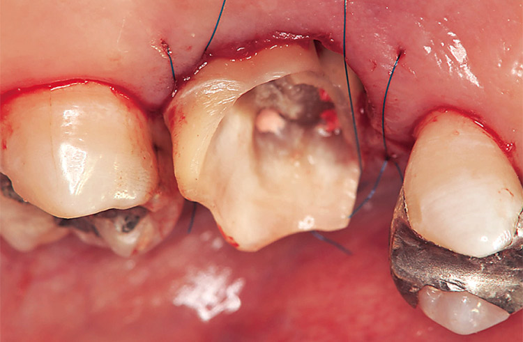 図24 フェルール確保のための歯冠長延長術直後