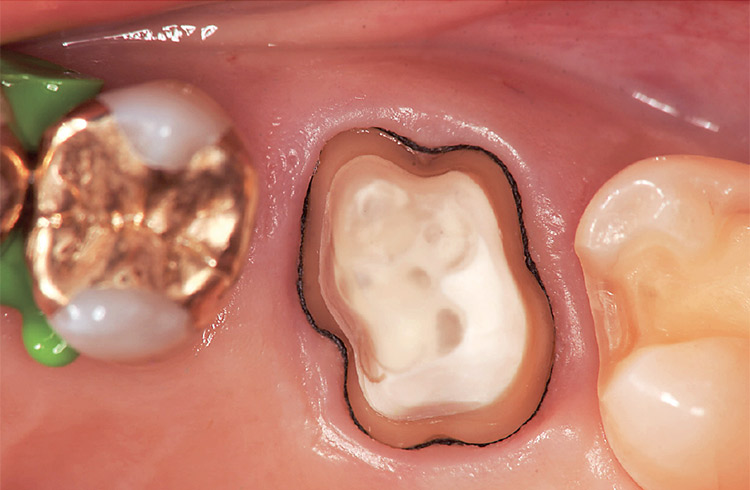 図25 フィニッシュラインは全周にわたって健全歯質に設定、印象採得時も出血がない。