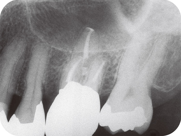 図27 最終補綴処置時のX線像。