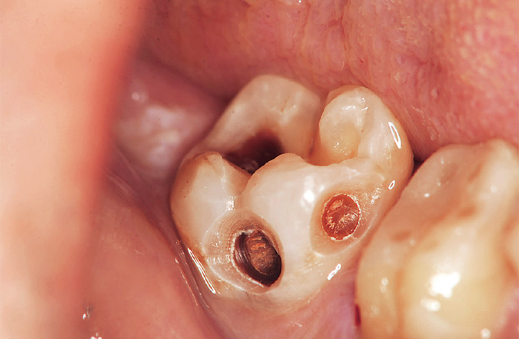 図5 インレー除去後、ラウンドバーで大まかな感染歯質除去を行う。