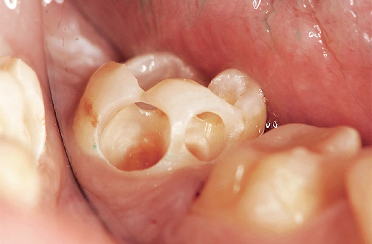 図6 ブラインド部分もミラーを用いて確認し、感染歯質除去を徹底する。