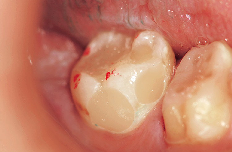 図7 体積が大きく複雑な窩洞の裏層となったが3回の照射で硬化完了。