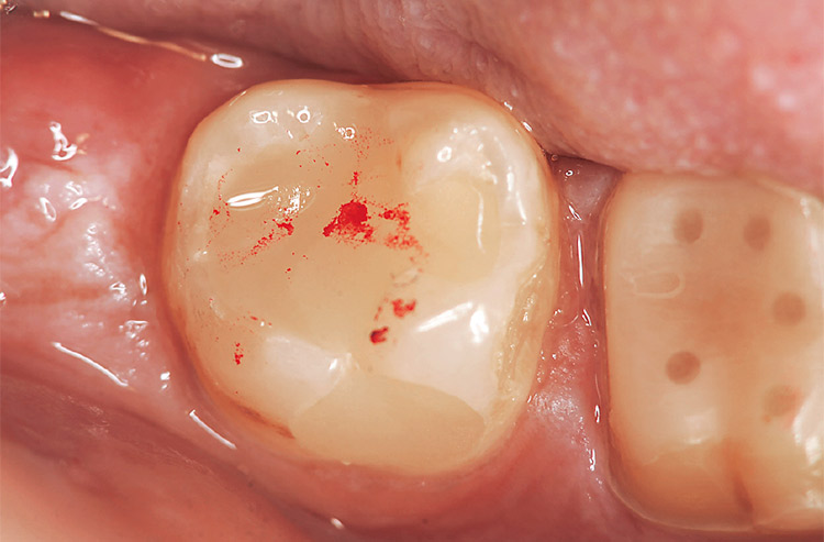 図8 3週間後、歯髄症状もなく、バルクベースの裏打ちにより菲薄なエナメル質のチッピングなども認めない。