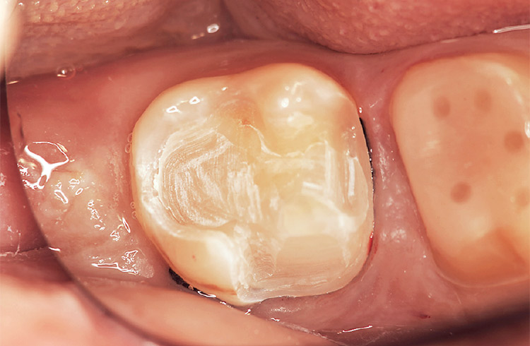 図9 フィニッシュラインは歯質に求める。バルクベースは乾燥させると歯質と識別しやすい。
