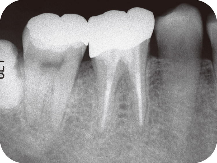 図11 最終補綴処置時のX線像。