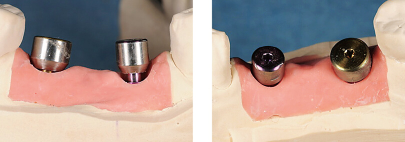 ⑨⑩ 口腔内では、写真⑨と⑩のヒーリングキャップが入れてあり、ヒーリングキャップの状態に歯肉が落ち着いているものが写真⑦の石膏模型の外側の点線のところになる。