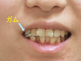 ガムの噛み過ぎによる側頭筋痛 弊害を生じます。