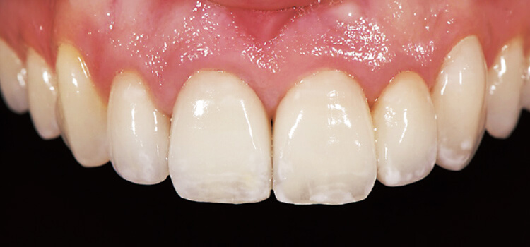 セラビアンZRを用いたジルコニアクラウンの症例（21 12）歯科技工士：青島仁　写真提供：Dr.Gerard J Chiche