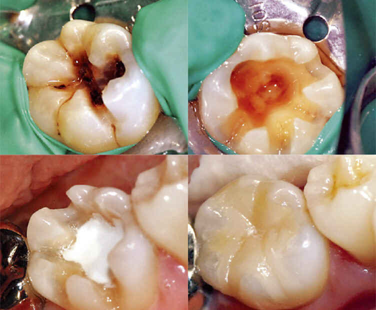 カリエスを除去すると、深い窩洞が見えた（左上、右上）。1.5mm厚の速硬性BioMTAのベース材を塗布すると（左下）、最初は物理的な封鎖、のちには化学的な封鎖が達成される。レジン・インレーで最終の修復治療を行った（右下）。