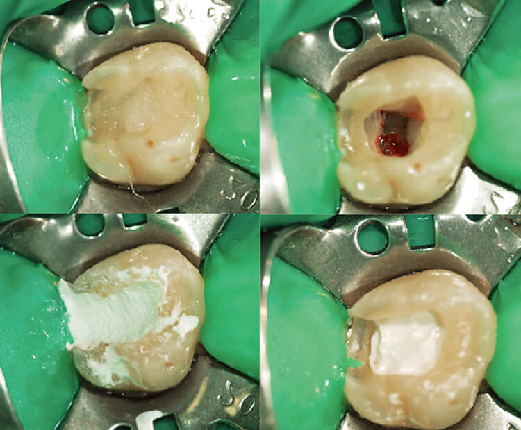 NaOClによる止血後、バイオセラミックスをベース材として分厚く塗布した。3分後高速ダイヤモンドバーで窩洞形成を行い、レジン・コアの作製を同日に行った。