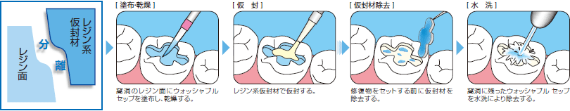 レジン面窩洞の仮封の図