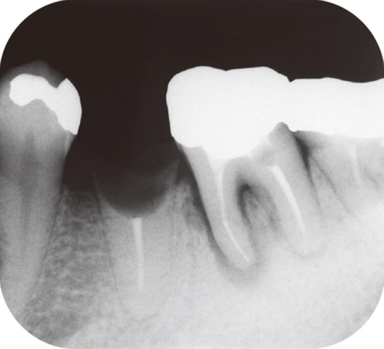 2007.9.26 6 デンタルX線写真。近心根周囲にびまん性の骨透過像を認める。