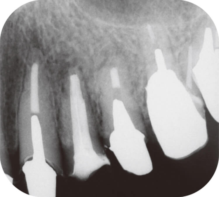 2013.1.21 根管充填後のデンタルX線写真。根管内の感染歯質を可能な限り除去し、SBシーラーにて根管充填。