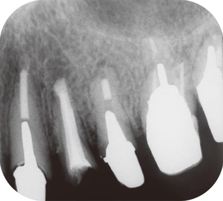 根尖掻爬後のデンタルX線写真。