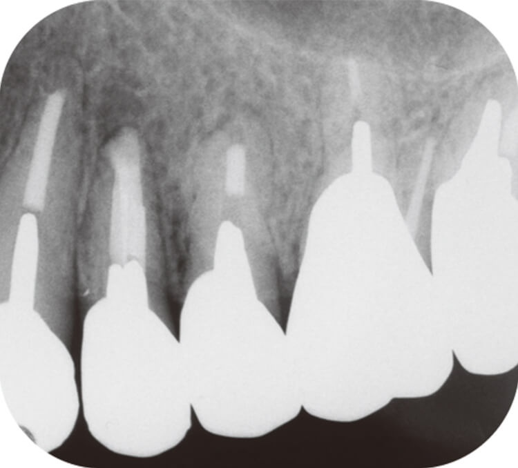 2015.1.8 最終補綴装置装着後のデンタルX線写真。根管充填から約2年経過。根尖部はフェネストレーションを起こしているものと推察されるが症状は無い。