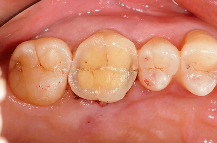 破折面接着後の咬合面観。この後に早急に根管治療へと移行した。