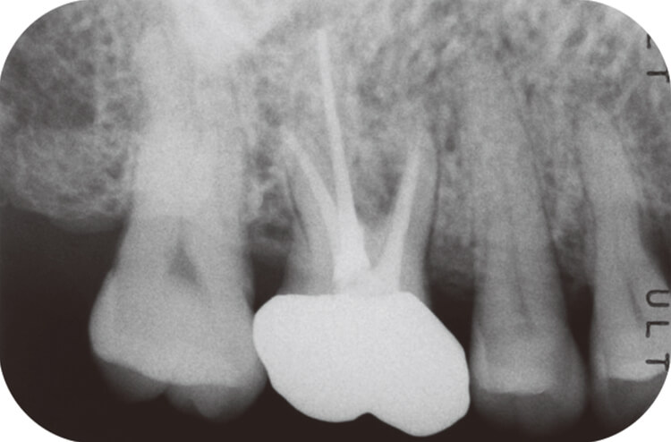 6 最終補綴装着時のデンタルX線写真。骨吸収像の改善を認める。