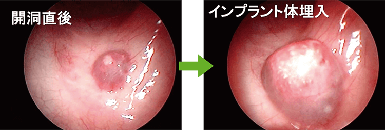 鏡視下で観察した理想的な挙上状態。開洞直後は剥離に伴う出血。3回の補填材を填塞しインプラント体を埋入した。血液の漏れはない。