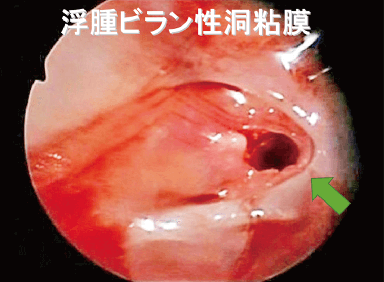 鏡視下でみた浮腫ビラン性洞粘膜。粘膜に弾力性はなく開洞時に容易に穿孔した。洞粘膜の厚さは約4mm（▶は粘膜穿孔部位）。