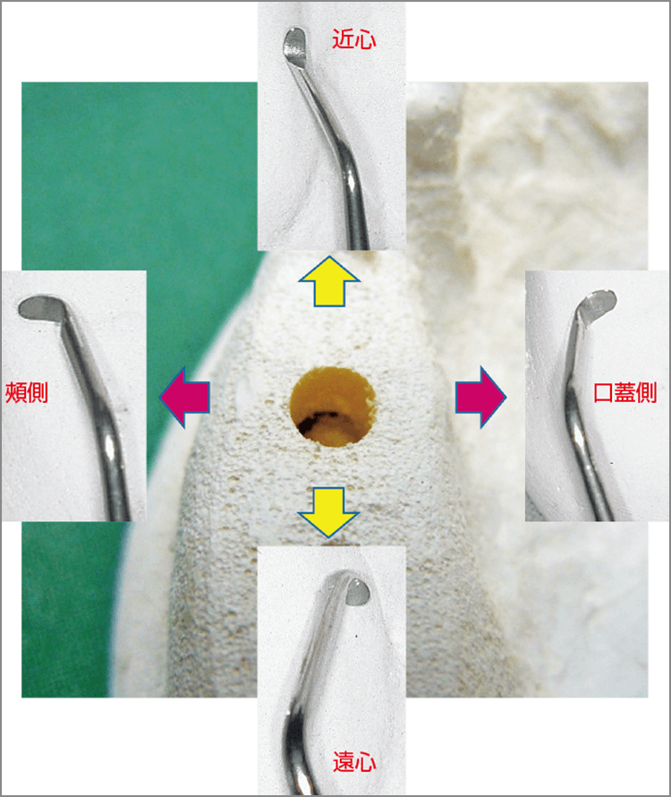 Line Neck:近遠心用と頰口蓋側用の両頭剥離子。それぞれが反対側を向いているため手の動きを変えることなく愛護的に剥離が可能。