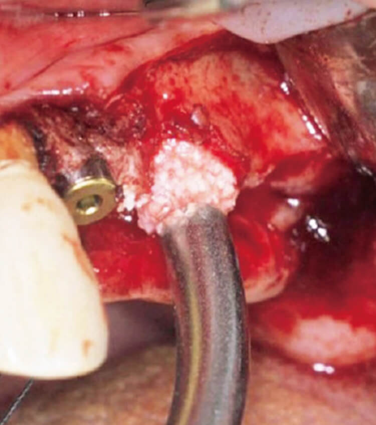 骨補填材の填塞量は1回約0.3gで数回行う。洞内から引きながら填塞する。