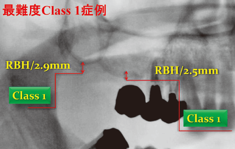 埋入部位のRBHは16→2.5mm、17→2.9mmと最難度である。
