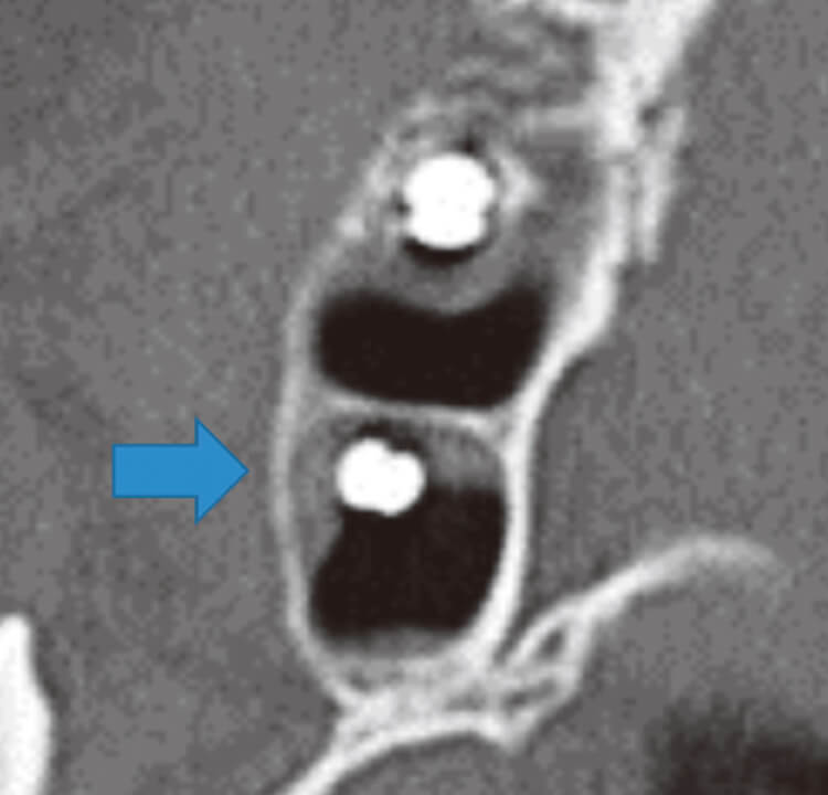 術後の水平断CT。17は前方の隔壁に接して埋入できた（▶）