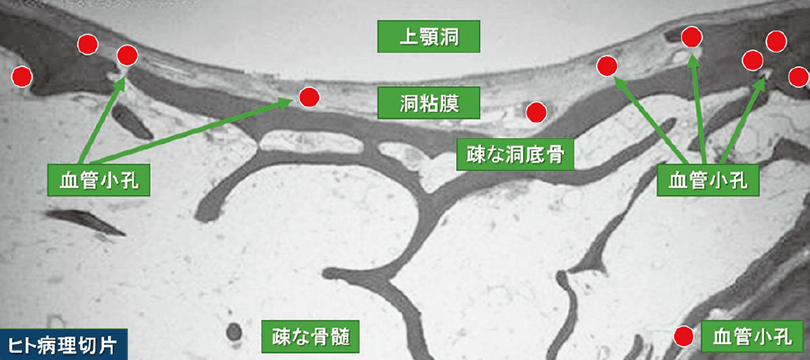 血管小孔を介して洞底部骨を貫通する栄養血管。TMサイナスリフトキットで剥がすことで骨再生に重要な出血を促す。